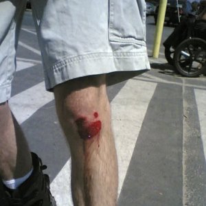 Local Resident: road rash on 28/10/2025 from 16:00-17:00